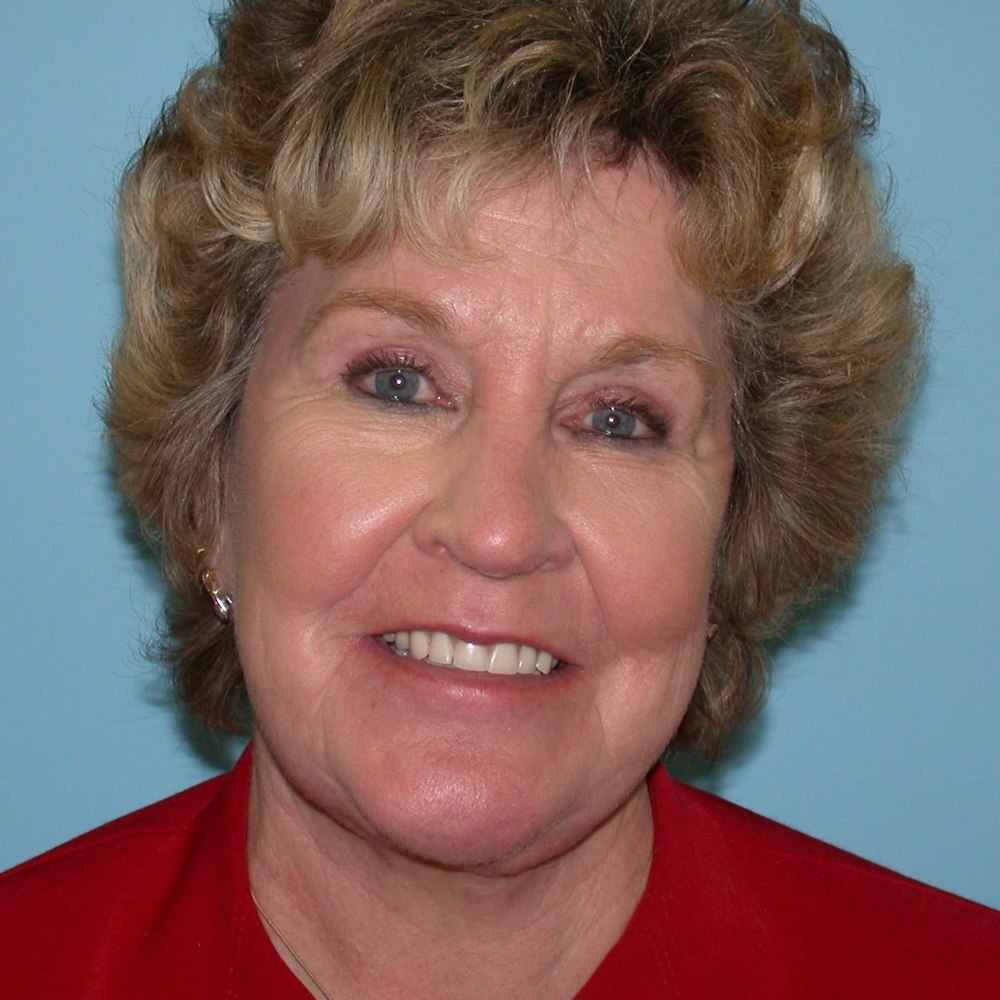 Patient after facelift