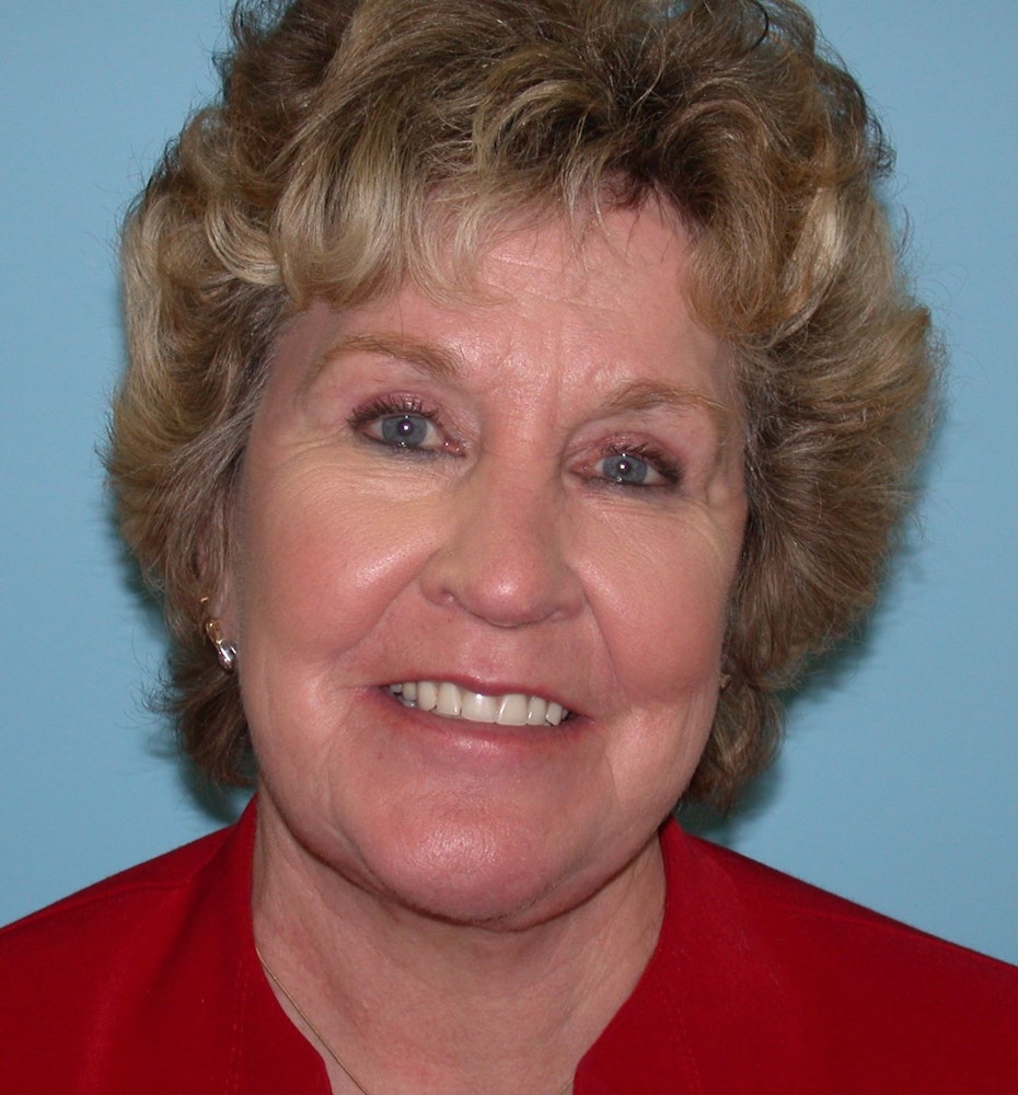 Patient after facelift