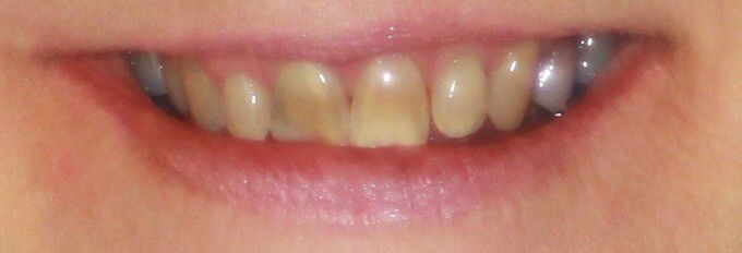 damaged smile prior to treatment with dental crowns