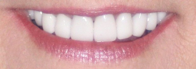 attractive smile after treatment with dental crowns