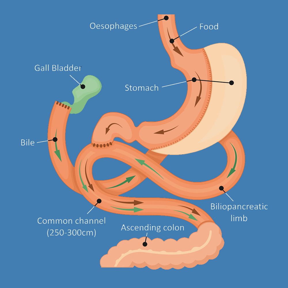 Diagram of stomach after SADI-s