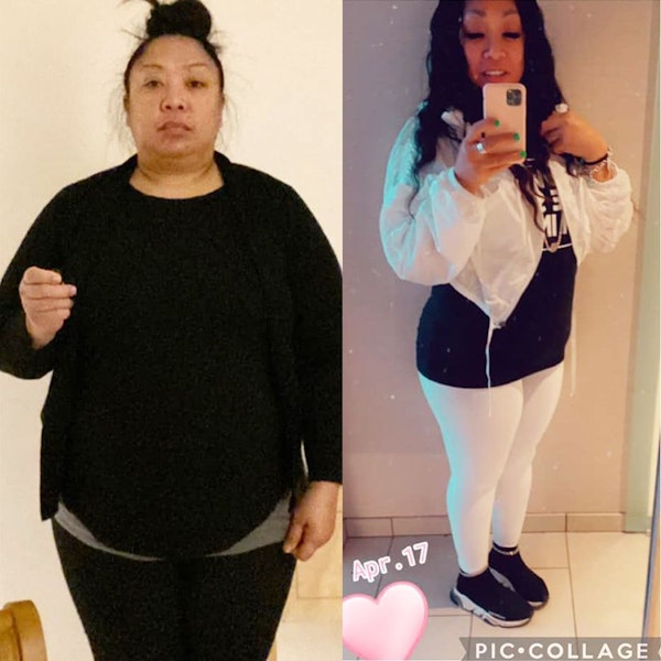 Young woman before and after gastric sleeve surgery