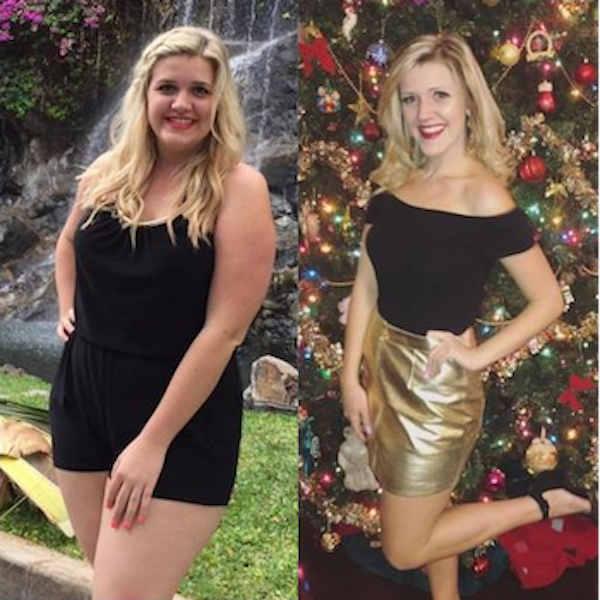 Young woman before and after gastric sleeve surgery