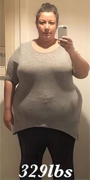 Before Gastric Sleeve Surgery