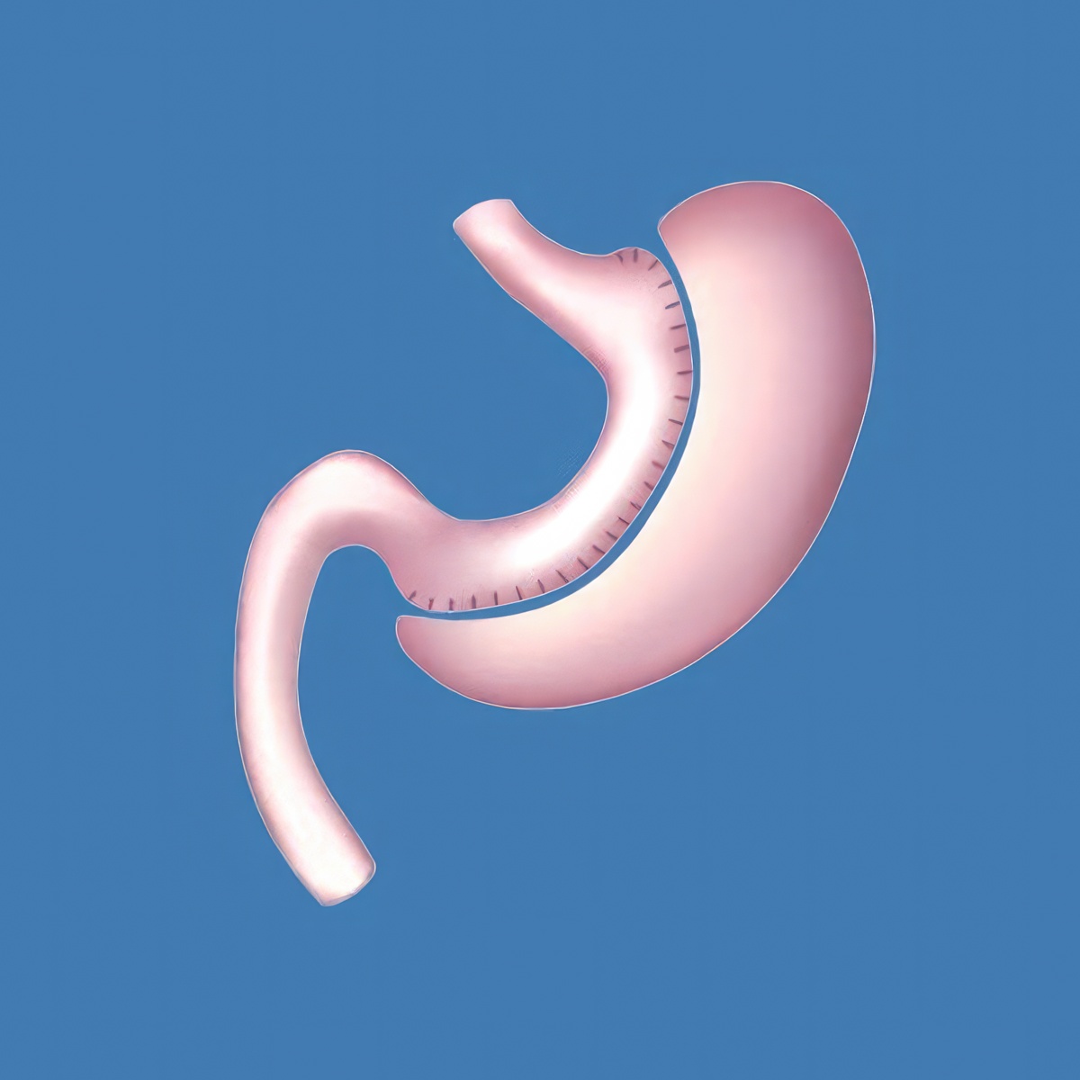 Stomach after gastric sleeve surgery