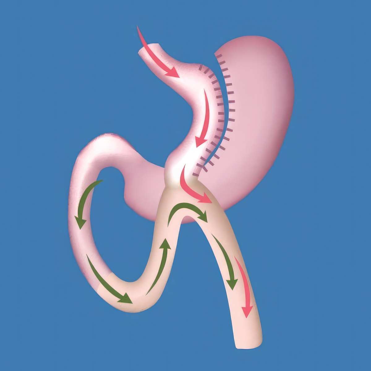 Diagram of stomach after mini gastric bypass surgery