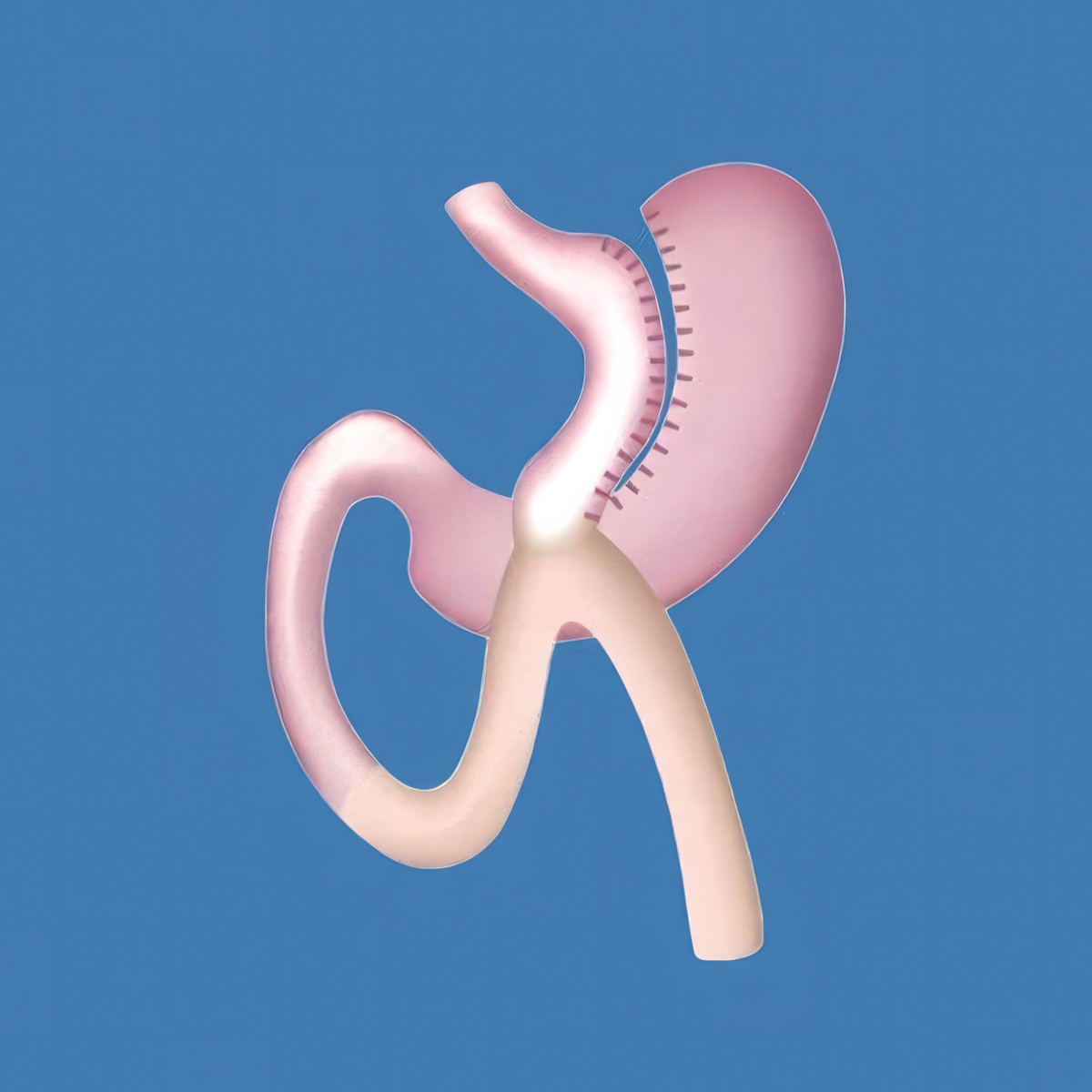 Stomach after gastric bypass surgery