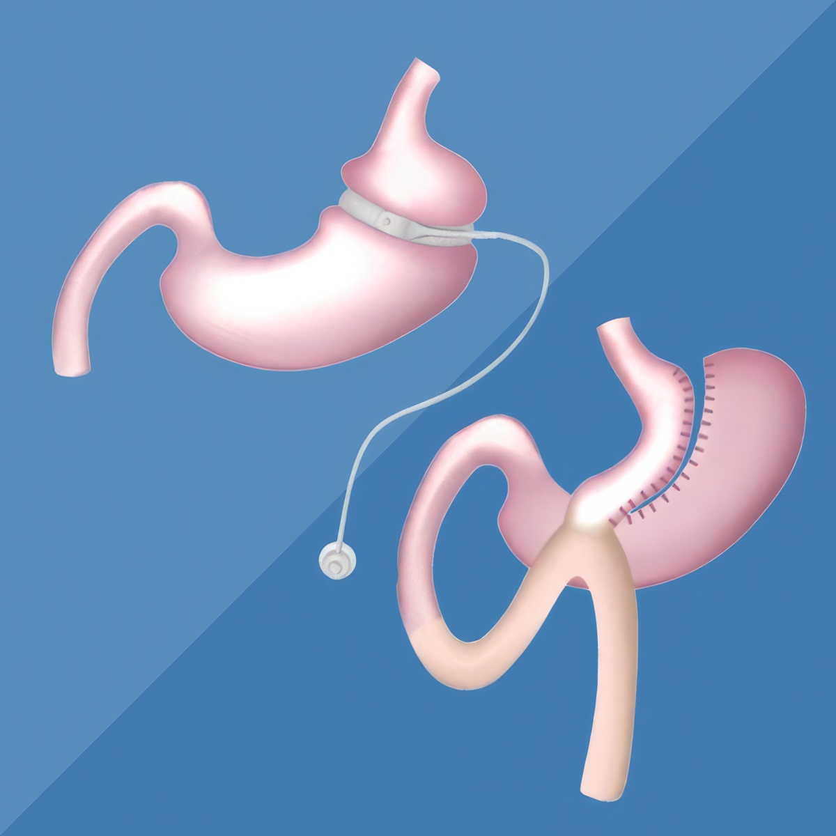 Before and after revision surgery