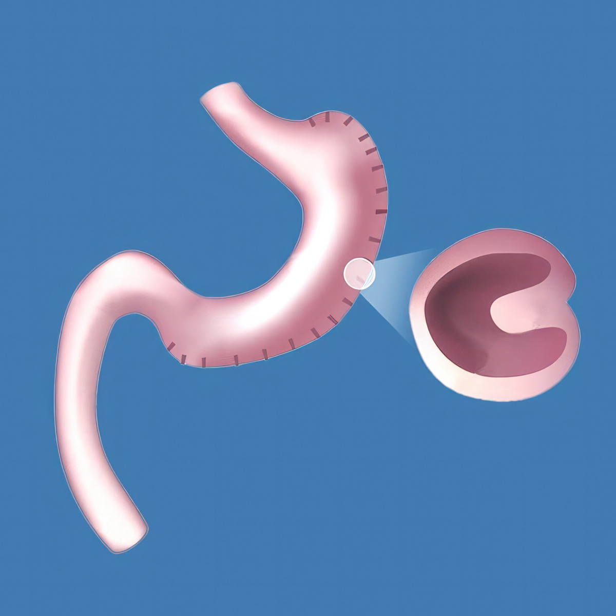 Stomach after gastric sleeve plication surgery