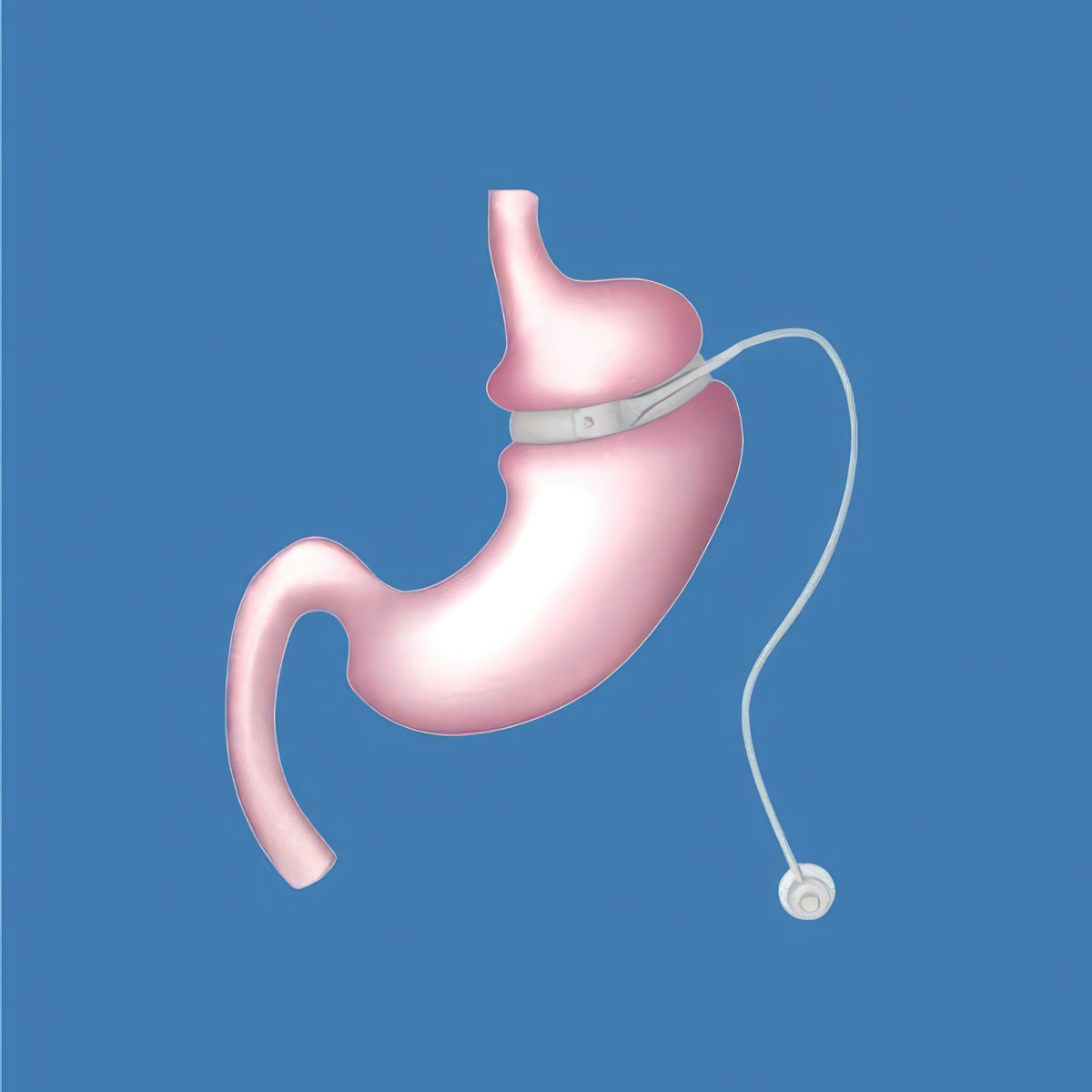 Stomach with LAP-BAND