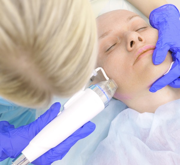 Bald woman receiving RF microneedling