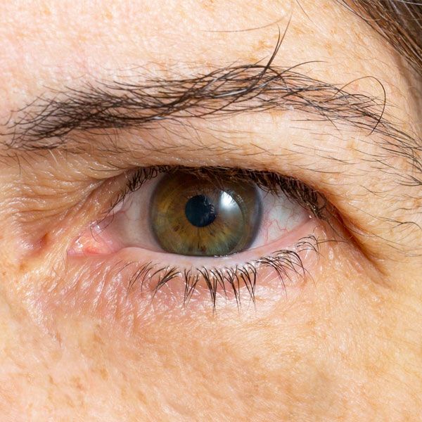 aged eyelid