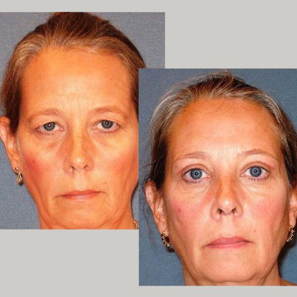 blepharoplasty patient