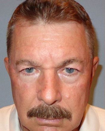 patient with saggy eyelids before blepharoplasty