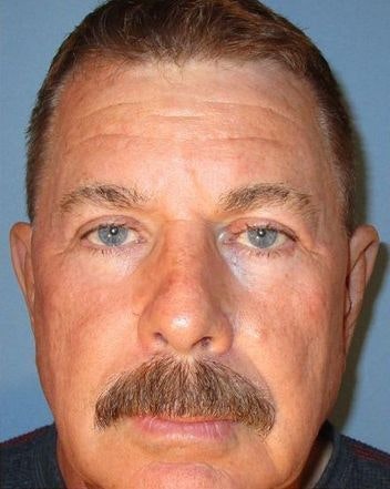 patient with tighter, healthier-looking eyelids after blepharoplasty