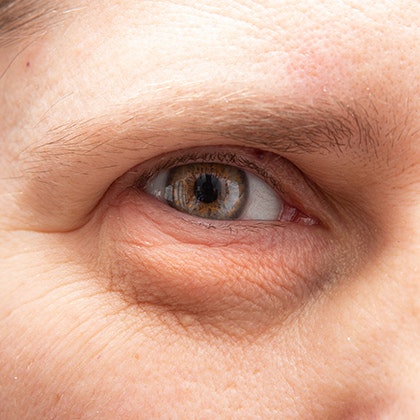 Baggy lower eyelid