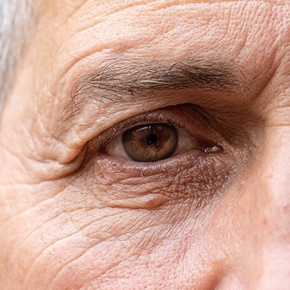 Fine lines and wrinkles around eyes