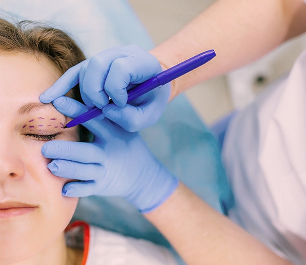 Eyelid surgery incision area being marked
