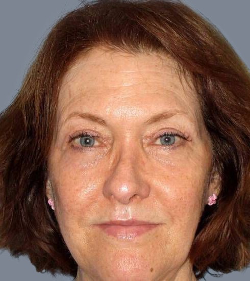 after eyelid surgery