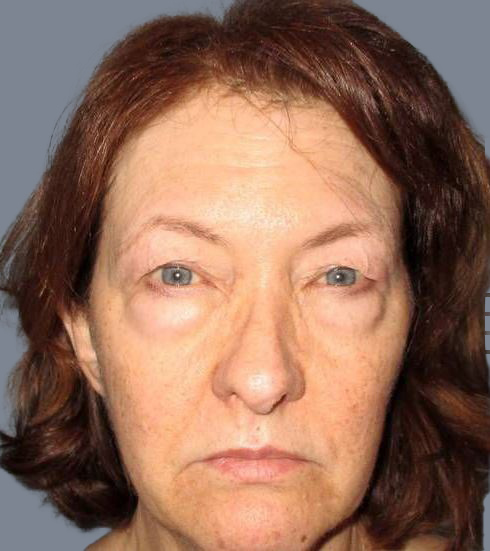 before eyelid surgery