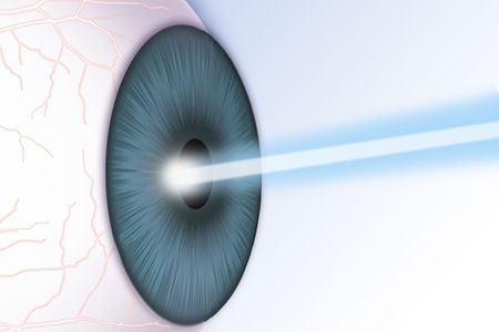 Laser correction illustration