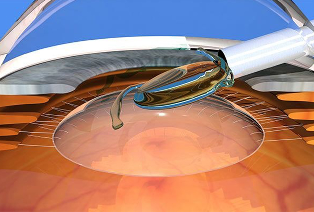Illustration of IOL placement on the eye