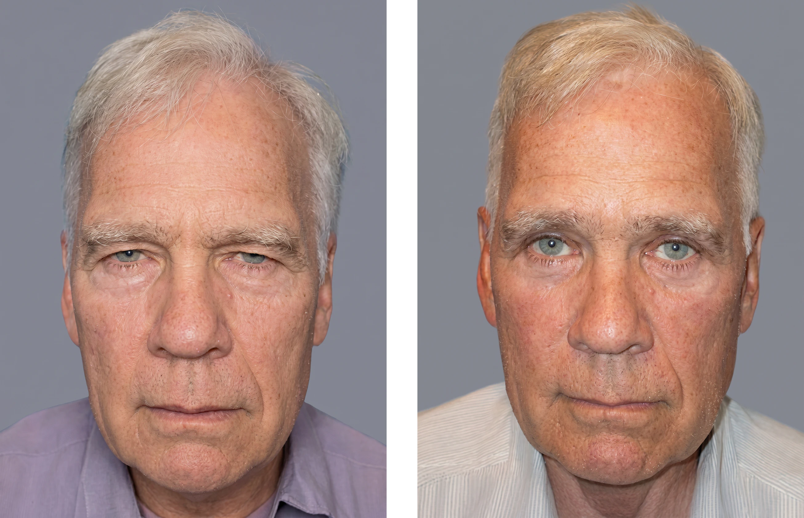 patient before and after blepharoplasty
