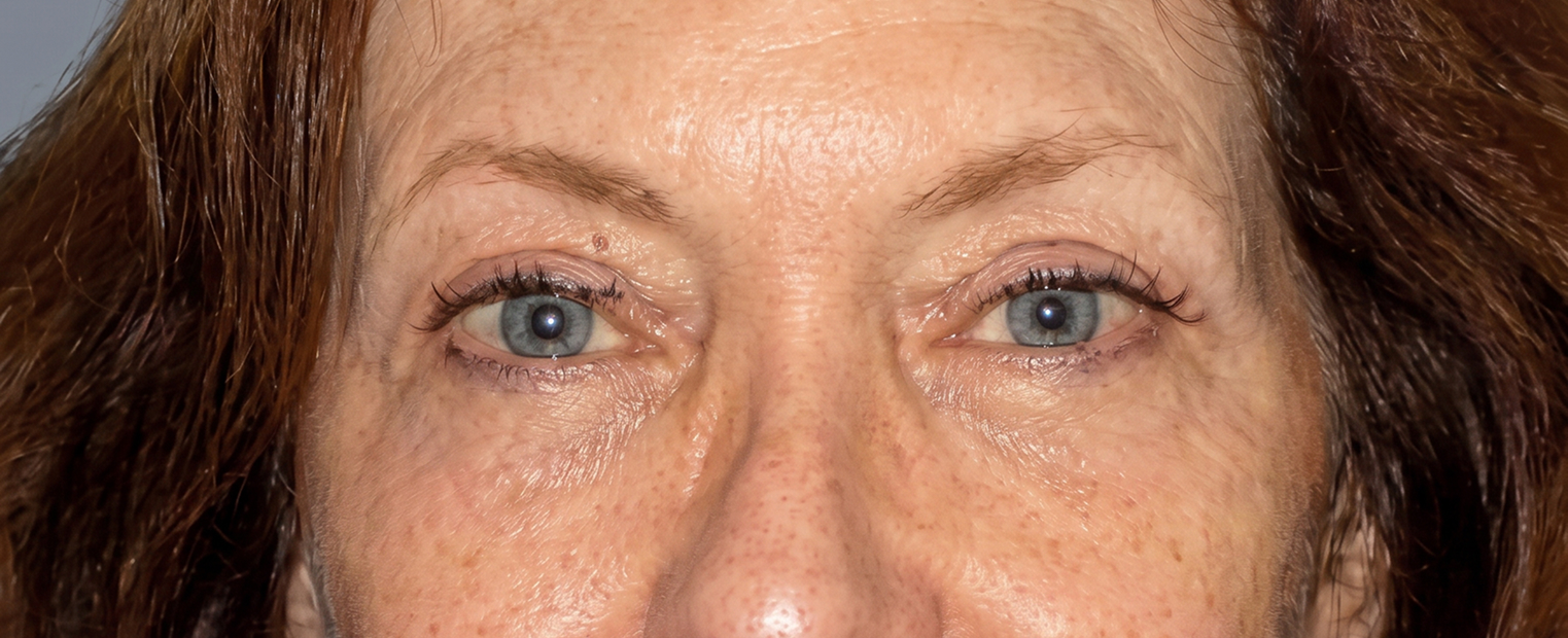 after eyelid surgery