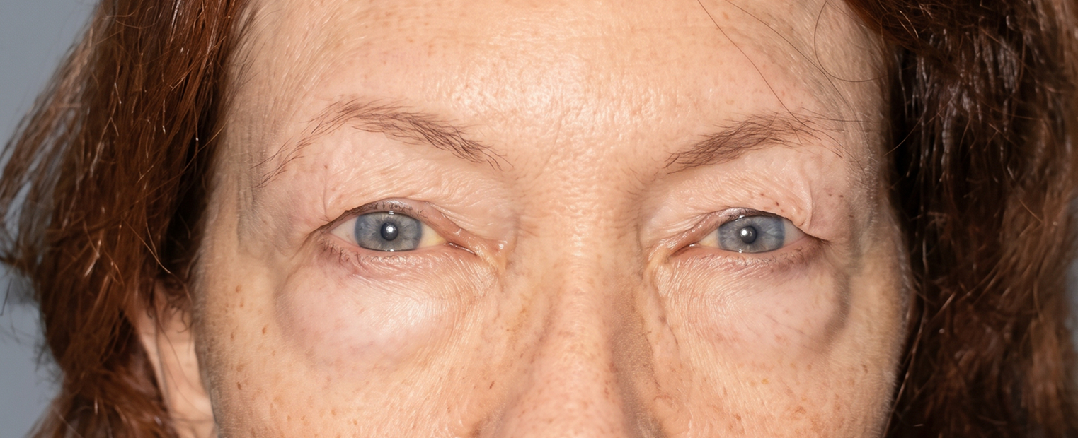 before eyelid surgery