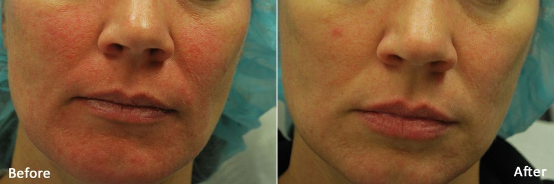 Morpheus 8 Before & After