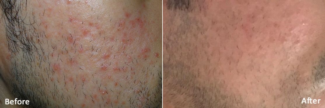 Morpheus 8 Before & After