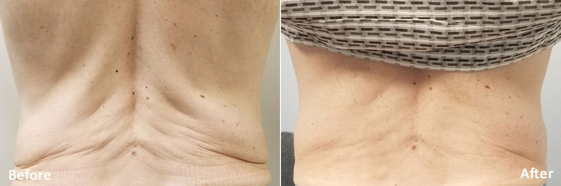 Morpheus 8 Before & After