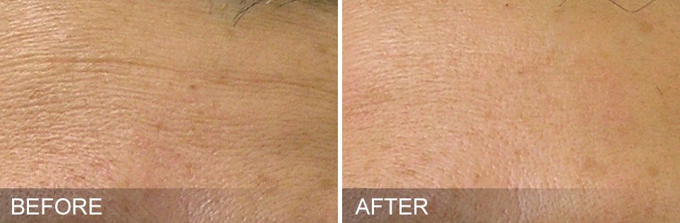 Hydrafacial Before and After