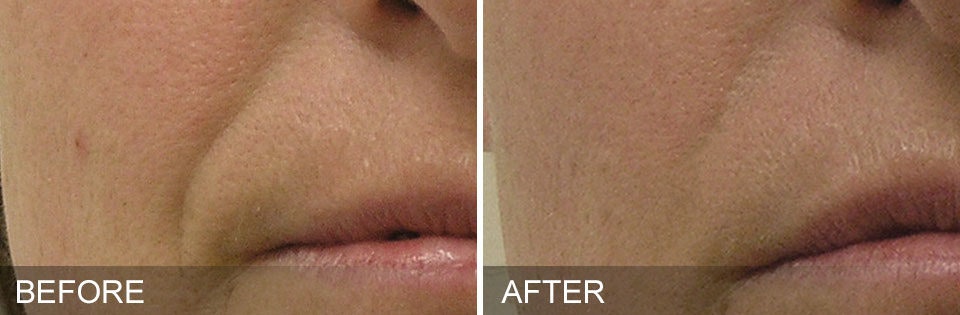 Hydrafacial Before and After