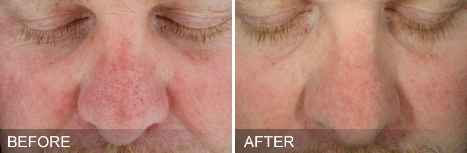 Hydrafacial Before and After