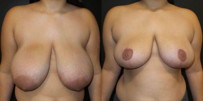 Breast reduction before and after