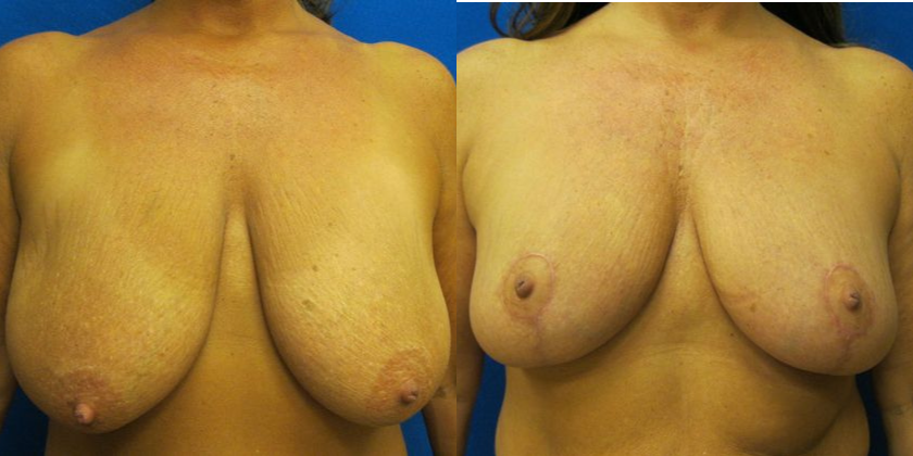 Breast reduction before and after