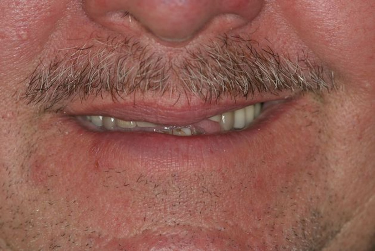 Smile of man with missing and crooked smile