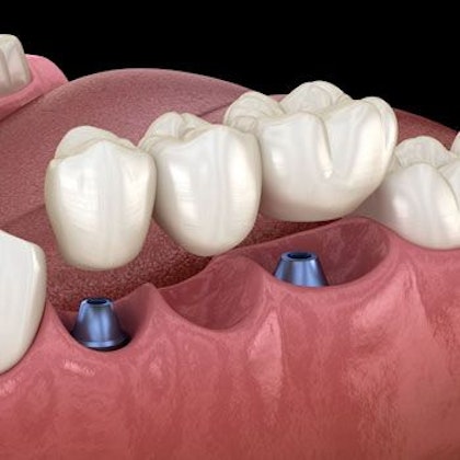 Dental Bridge