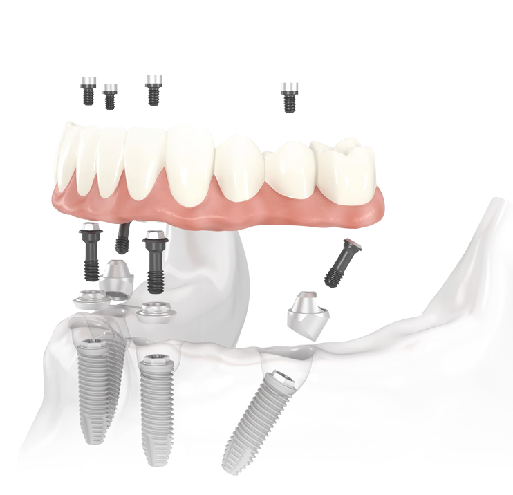 All-On-4 Implants