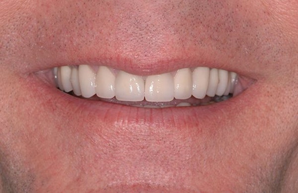 After full mouth reconstruction