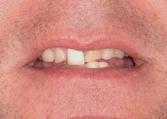 Before full mouth reconstruction