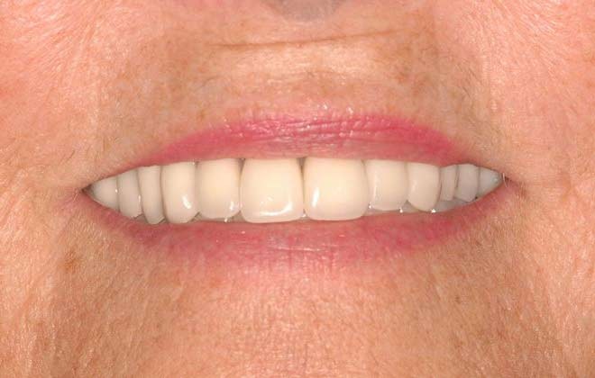 After Image of great teeth