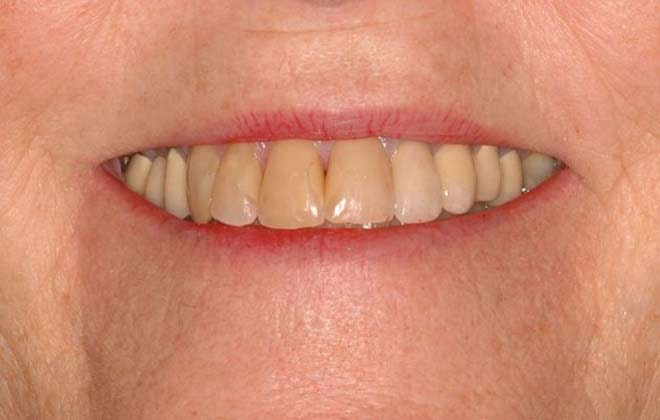 Before image of bad teeth