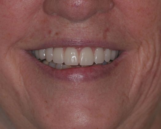 Ridgewood Dental Associates patient after all-on-4