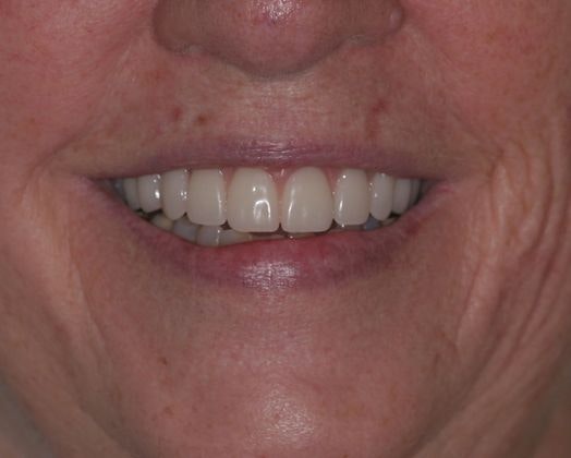 Ridgewood Dental Associates patient after all-on-4