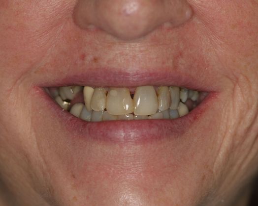 Ridgewood Dental Associates patient before all-on-4