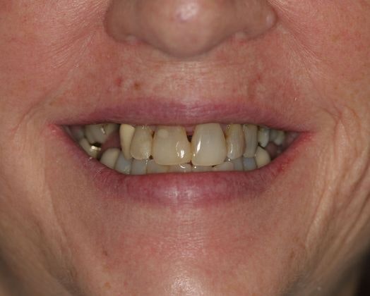 Ridgewood Dental Associates patient before all-on-4