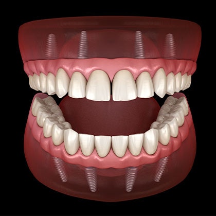 All-on-4 Dental Implants