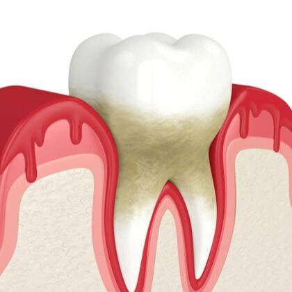 Ask a Periodontist - How Can Gum Disease Harm Your Teeth and Jawbone?